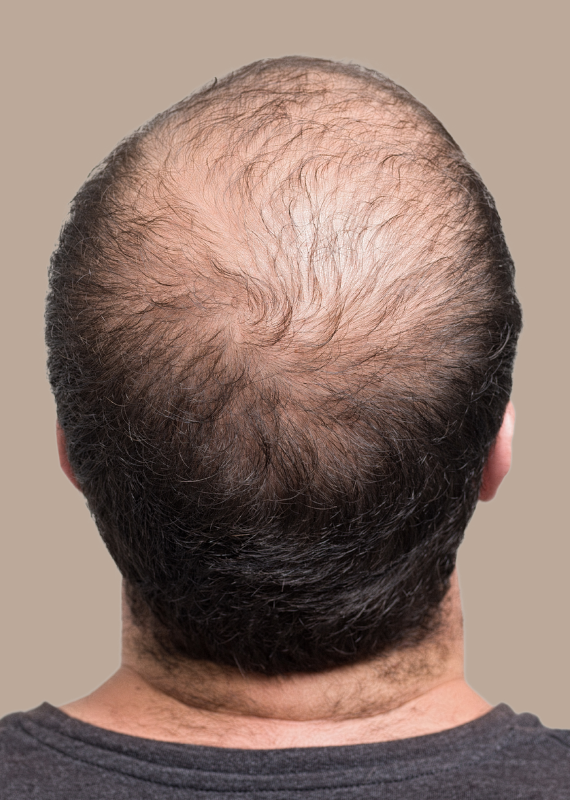 Alopecia Androgenética